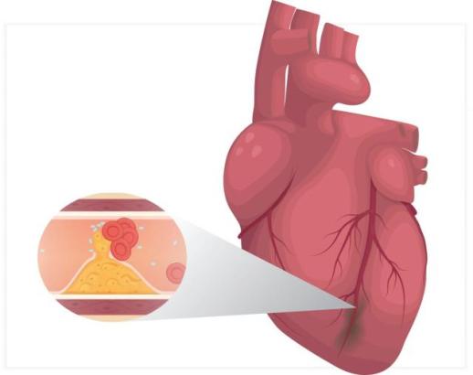 [안서희의 라이프 리포트] 겨울철 심근경색 경고등…몇 시간 차이가 생명 좌우