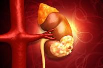 [안서희의 라이프 리포트] 지방간, 젊은 신장암 부른다…20~30대 위험 최대 2배 증가