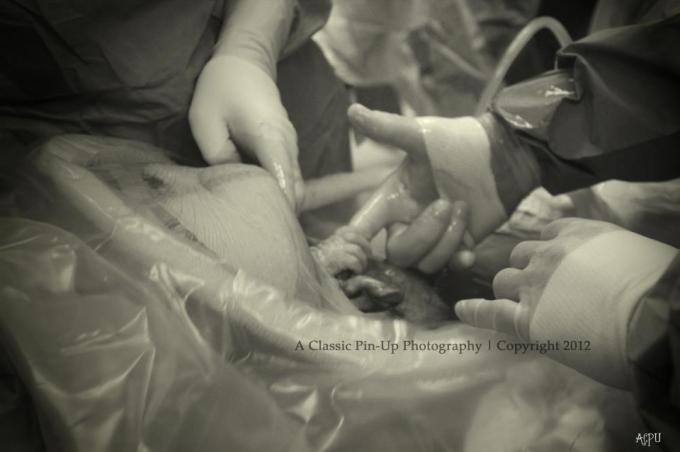 A photo of unborn baby reaching out from mother’s womb to grab a doctor’s finger during C-section