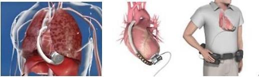​[K메디···병원이 간다] 한림대 동탄성심병원, 좌심실 보조장치 수술 경기도내 첫 성공