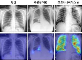 State research institute develops more accurate AI-based chest X-ray COVID-19 diagnosis algorithm
