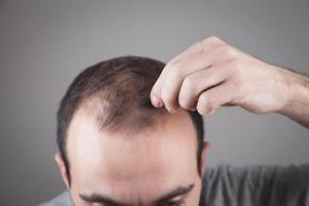 Viola verecunda extracts found to be effective in hair growth and hair loss control