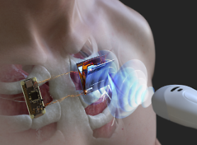 Researchers develop acoustic wireless charging technique capable of charging electronic implants
