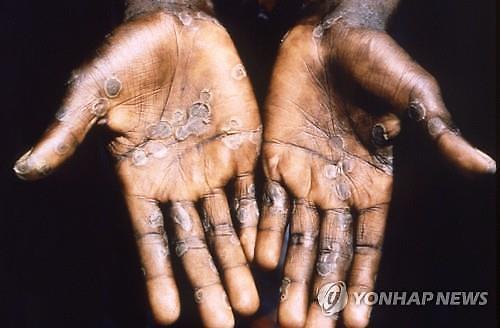 [NNA] 캄보디아, 원숭이두창 의심 6명 전원 음성