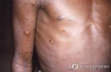 [NNA] 싱가포르에서 원숭이두창 감염자 확인, 밀접접촉자 13명