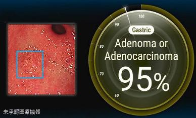 [NNA] AI메디컬서비스, 위암 감별 AI 개발