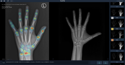 VUNOs AI bone age assessment solution wins approval from Taiwans health department 