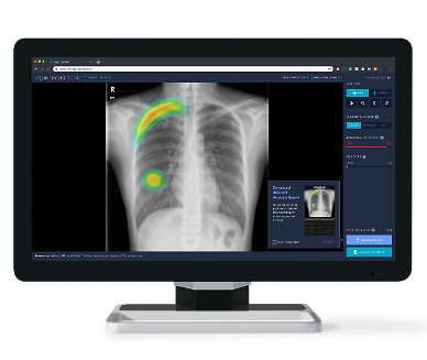 Brazilian hospital adopts Lunits AI chest x-ray solution 