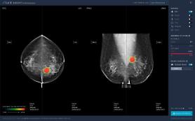 ​Lunits AI solution for breast cancer to be provided in Hong Kong and Mongolia