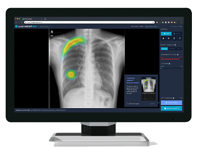 Singaporean medical imaging service provider Radlink to adopt Lunits AI chest x-ray solution