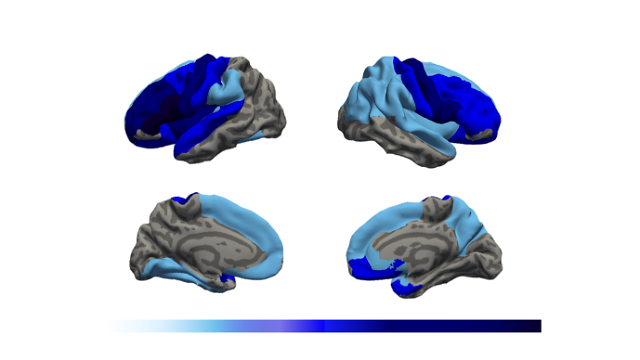(위) 대뇌의 바깥쪽, (아래) 대뇌의 안쪽, 짙은 파란색일수록 뇌 주름의 정도가 감소되어 있음을 의미