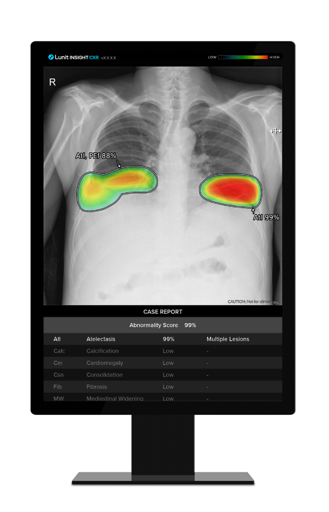 State-run police hospital adopts Lunits AI chest X-ray solution