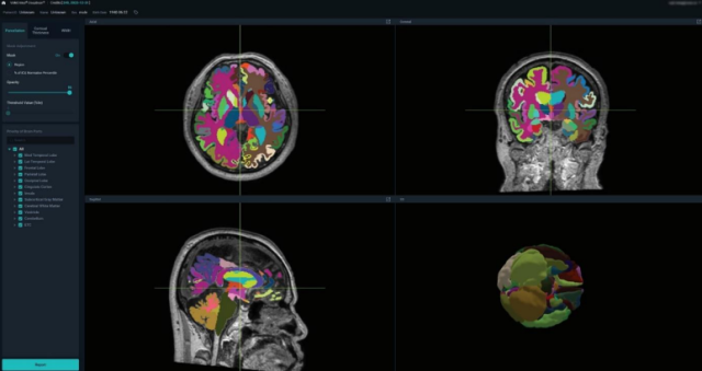 VUNOs AI brain image analysis solution wins US health departments approval as medical device
