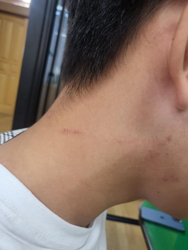 대전 한 사립고에서 담임교사에게 폭행 당한 학생의 목에 남은 흔적 사진연합뉴스