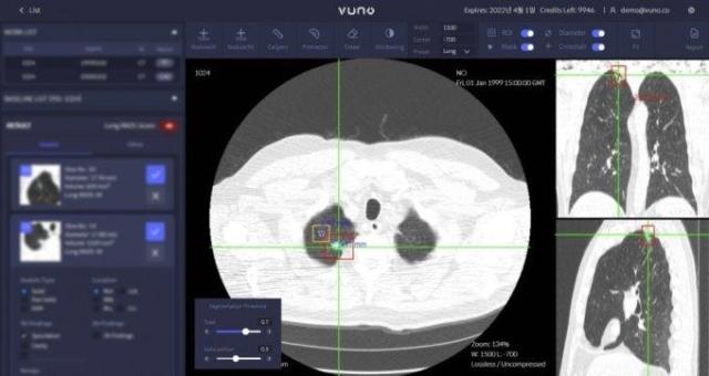 VUNO、『胸部CT AI』日本健康保険適用···「海外売上拡大期待↑」