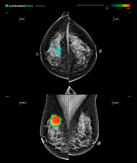 Researchers find Lunits AI image analysis solution effective enough to reduce human doctors workload