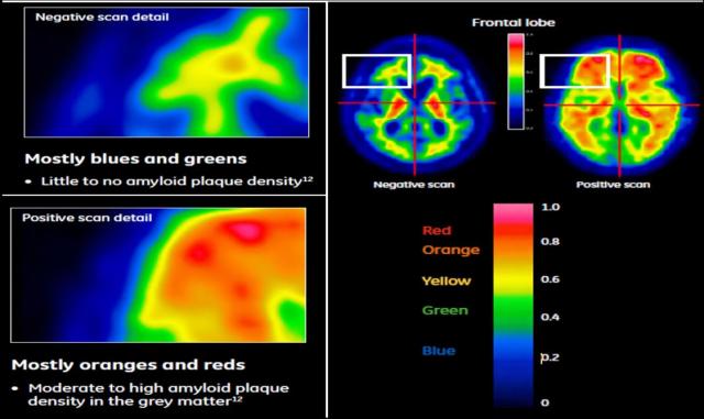치매 진단 방사성의약품 ‘비자밀’을 이용한 진단 이미지 컬러가 블루 및 그린인 경우 베타 아밀로이드 신경반 밀도가 거의 없다고 판단하며 오렌지 및 레드일 경우 중증도 이상의 알츠하이머성 치매일 가능성이 높다 사진듀켐바이오