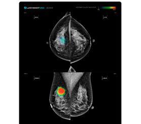 Qatar adopts Lunits AI solution for breast cancer screening project