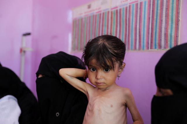 A malnourished Yemeni girl waits in a hospital’s measurement room in Sanaa Yemen on Mar 2 2024 in this file photo Reuters - Yonhap