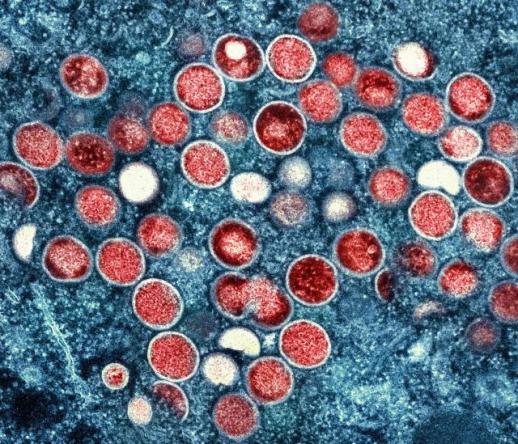 India reports first case of variant mpox