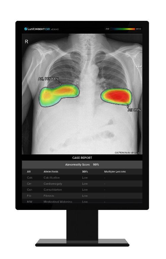 루닛의 흉부 엑스레이 AI 영상분석 솔루션 인사이트 CXR 사진루닛
