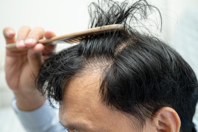 Hair transplant costs vary up to 15-fold across South Korea