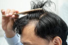 Hair transplant costs vary up to 15-fold across South Korea