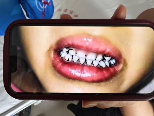 中 유치원 덮친 납중독…아이 머리 빠지고 치아 까매져