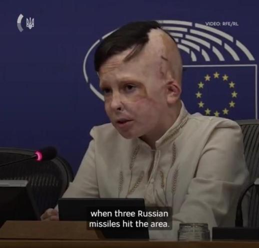 우크라 아이들 계속 도와주세요…러, 공습에 35번 수술한 아이의 호소