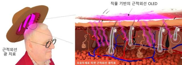 직물 기반 근적외선 OLED 모자를 이용한 광 치료 모식도사진KAIST 