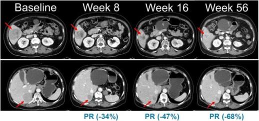 NRAS 변이 흑색종 공략…한미약품 임상 본격화