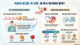 Nguy cơ ung thư từ polyp dạ dày: Không thể chủ quan