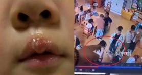 Teacher Burns 4-Year-Old Girls Lip with Hot Glue Gun in China