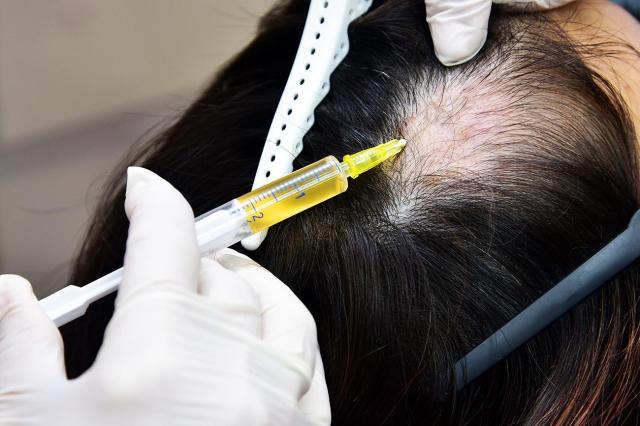 A medical worker performs a scalp injection procedure as part of hair loss treatment Courtesy of Yonhap News Agency