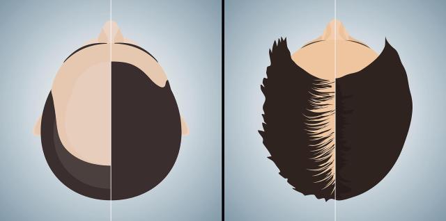 An illustration compares typical male and female hair loss patterns showing a receding hairline and crown thinning in men alongside more diffuse thinning across the scalp in women Courtesy of Yonhap News Agency