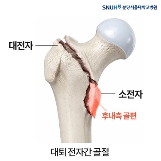 분당서울대병원 고관절 골절, 뼛조각 고정보다 정확한 맞춤 중요