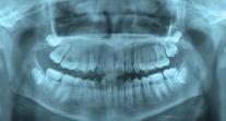 Người phụ nữ 70 tuổi tử vong sau khi cấy ghép 11 implant tại nha khoa ở Gangnam